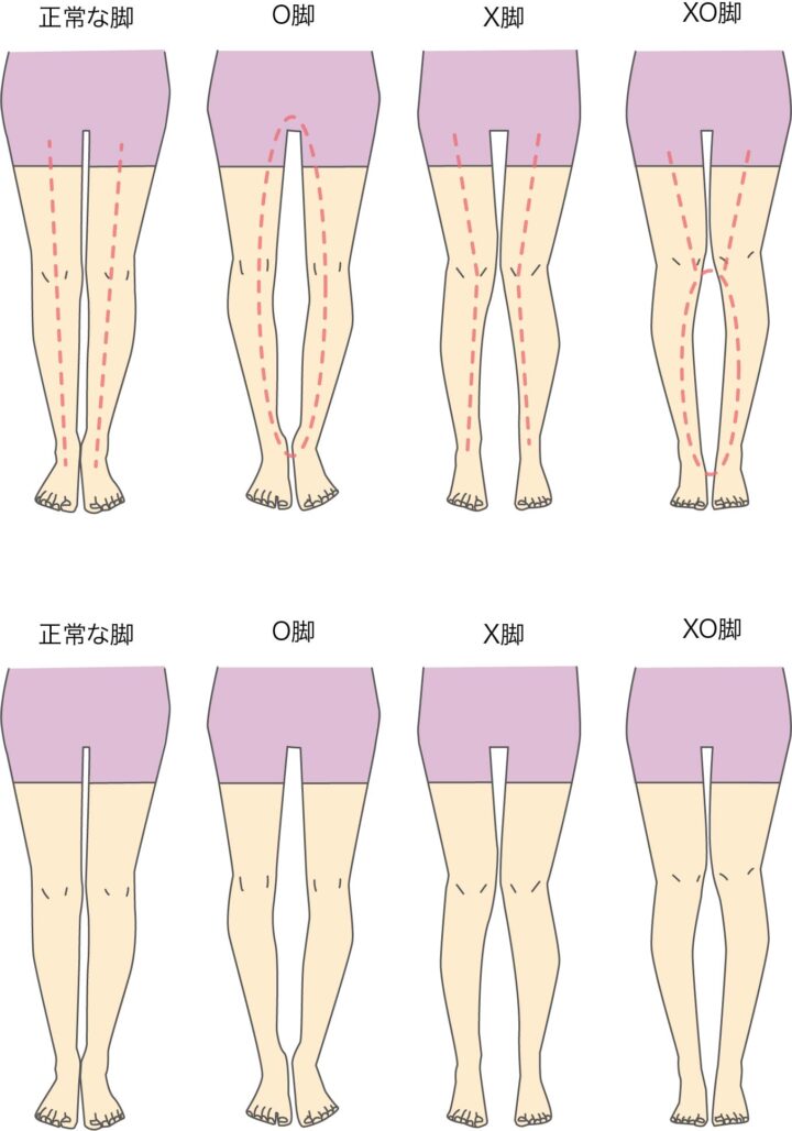Ｘ脚は太る原因なのか？もし太る原因なら病院は行くべきか？の画像