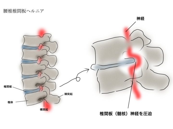 腰痛を予防する為の筋トレとは？の画像